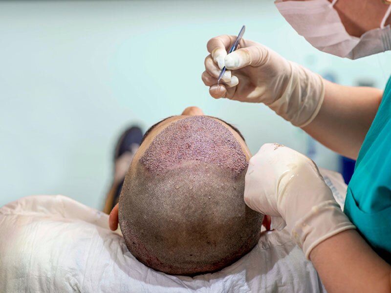 hair-transplant-img1-the-cosmetic-club-2022