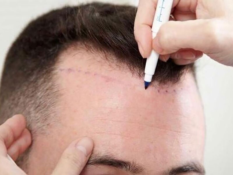 hair-transplant-img4-the-cosmetic-club-2022