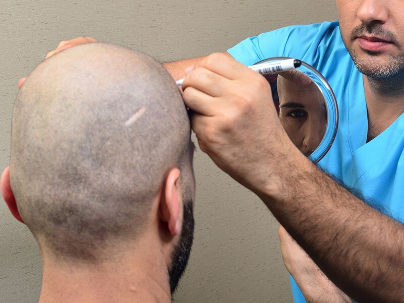 hair-transplant-img2-the-cosmetic-club-2022